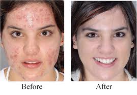 Stopping Acne