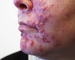 Getting the right acne treatment can be challenging