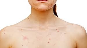 Skin Acne It Does Not Matter How Clean You Are You Can Still Get Acne Anywhere On Your Body