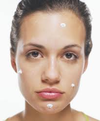 Help For Acne Naturally