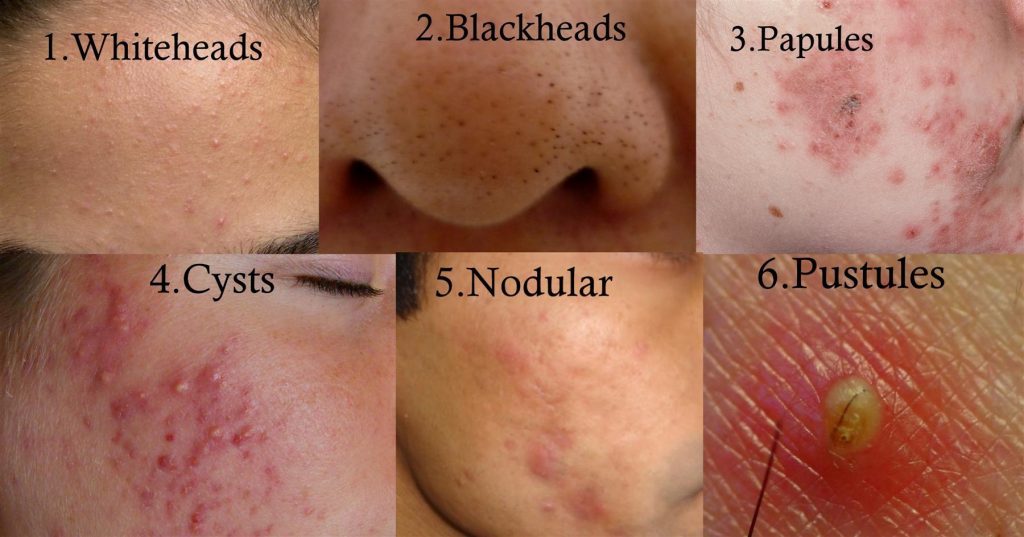 Types Of Acne